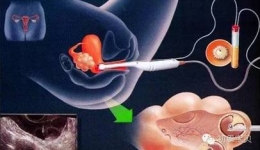体外受精—胚胎移植术（IVF-ET）