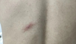 7月新增491例，他们正与猴痘“交锋”